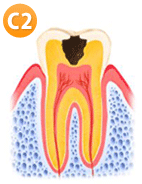 虫歯ステップ2