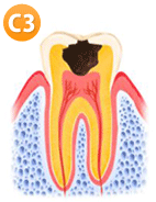 虫歯ステップ3