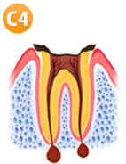 虫歯ステップ4