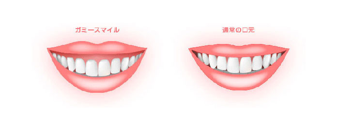 ガミースマイルイラスト