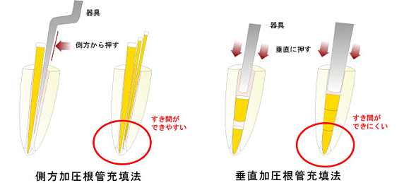 ”垂直加圧”