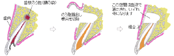 ”歯根端切除術”
